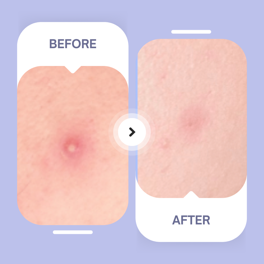 Hydrocolloid Acne Patches – Overnight Blemish Treatment
