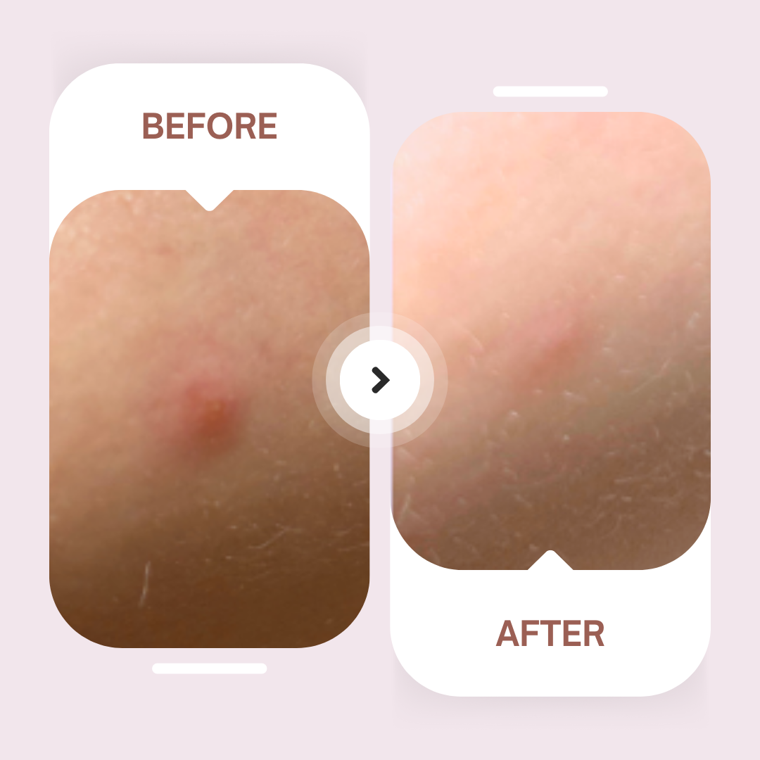 Invisible Acne Patches – Ultra-Thin Daytime Treatment